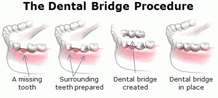 dental bridge diagram