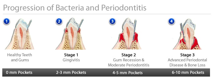 Progression of Bacteria and Periodontitis 