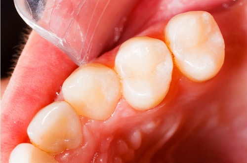 Brandon, FL dental patient's teeth after cavity filling