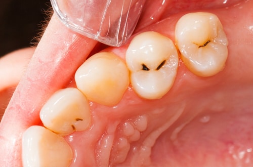 Brandon, FL patient's teeth before cavity filling