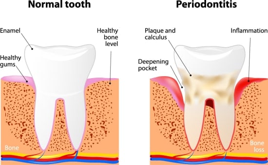 Gum disease diagram showing a normal tooth and one that is infected. 