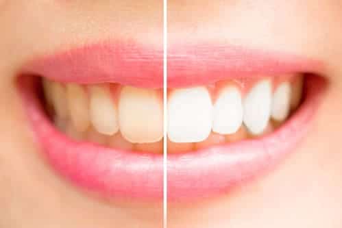 Before and after of a women who got professional teeth whitening in brandon fl