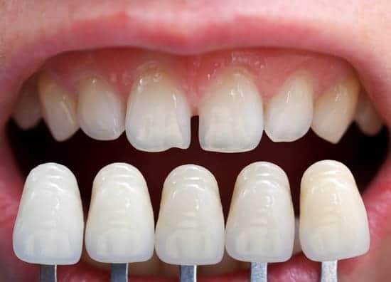 Patient mouth with missing teeth before dental implant procedure