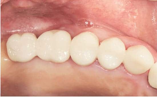 Brandon dental patient's back teeth with crown on after getting dental implants.