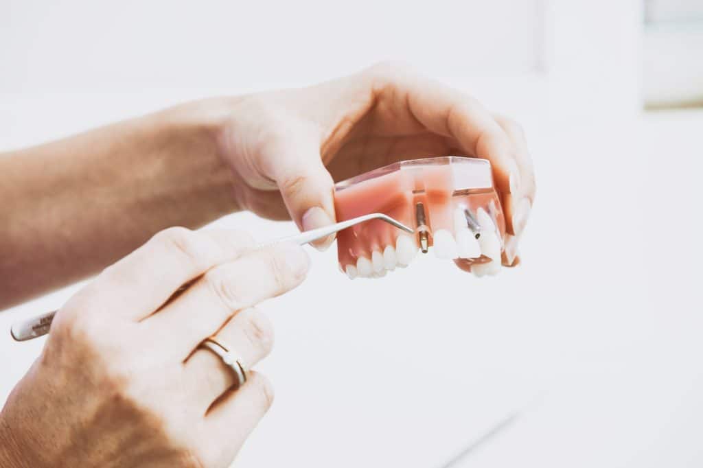 How Brandon FL dental implants work