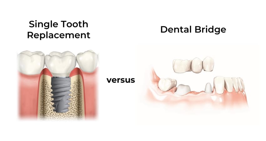 Diagram of single tooth replacement versus dental bridge