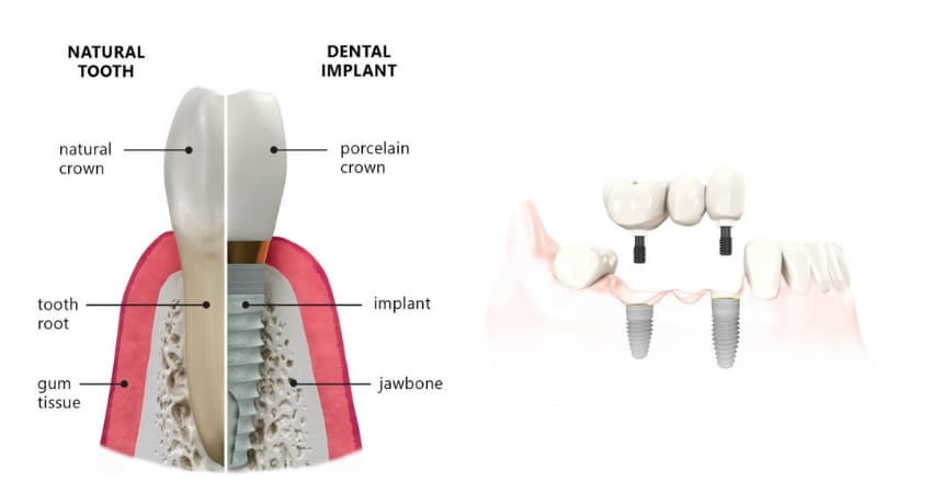 Informative diagram about single and multiple teeth replacements