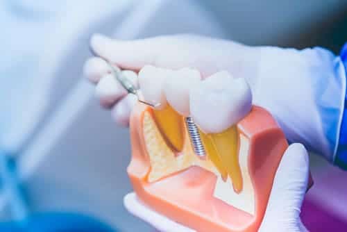 A realistic 3D model of a dental implant being held by the hands of a dentist