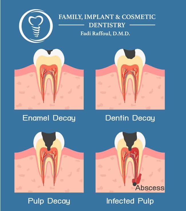 Dental Abscess - Stages, Causes, Symptoms & Treatments | Blog
