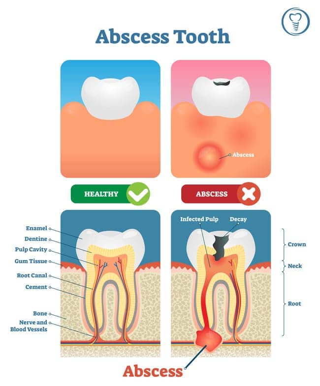 The Diagram of Tooth Abscess