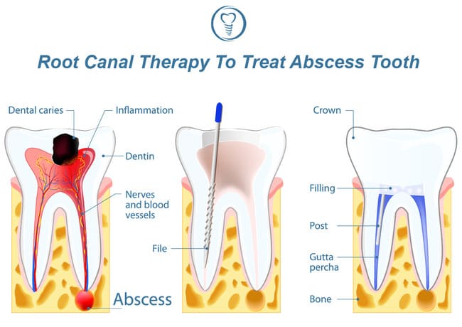 A diagram representing the root canal procedure
