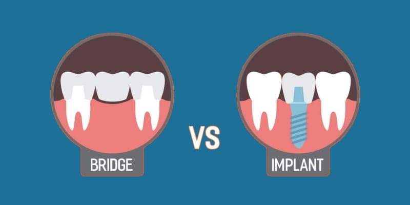 Differences Between Dental implants and Bridges