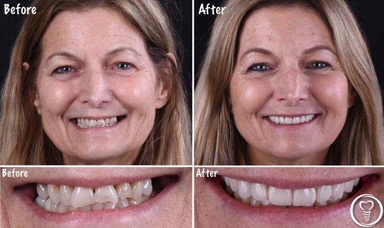Dental before-and-after treatment