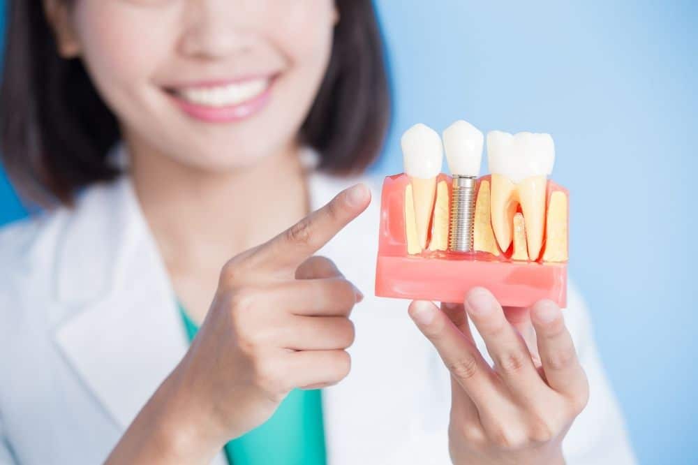 Dentist holding a model showing a dental implant