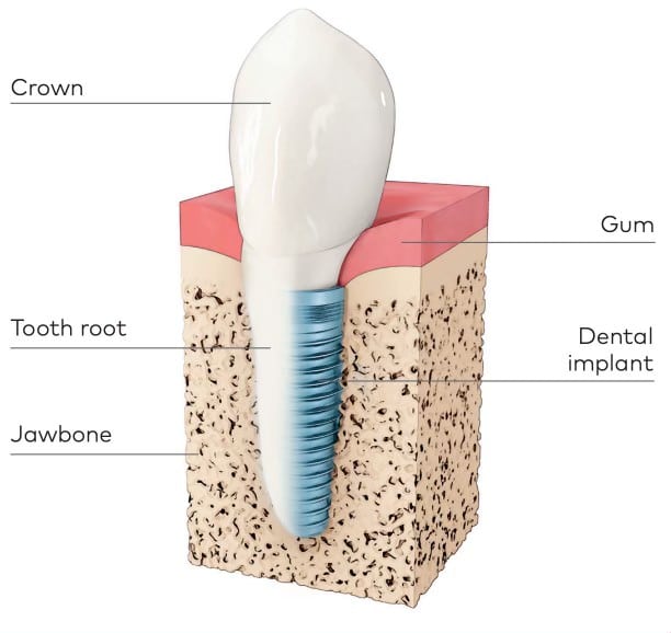 The different parts of a dental implant