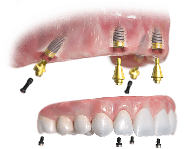 Removable Implant Supported Dentures 00003_00