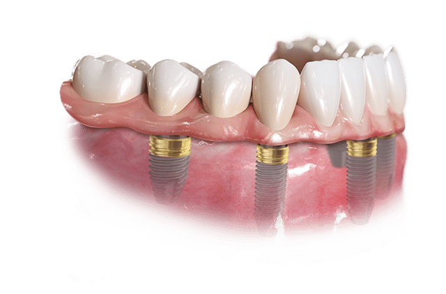Removable Implant and Cosmetic Dentistry Brandon Florida