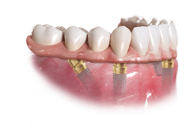 Removable Implant Supported Dentures Parallell AllOn4