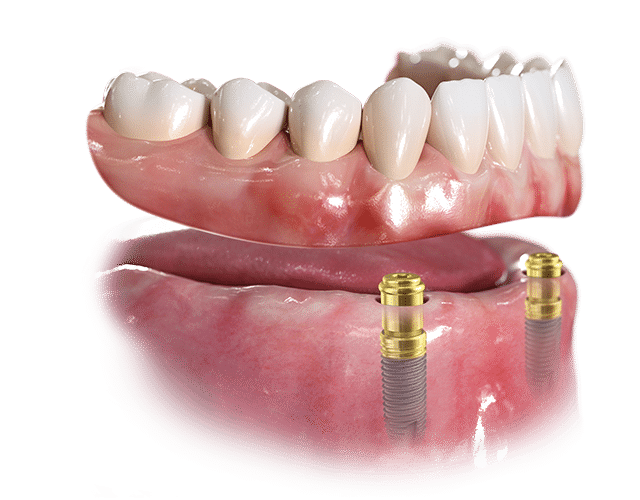 Removable Implant Supported Dentures Parallell MUA