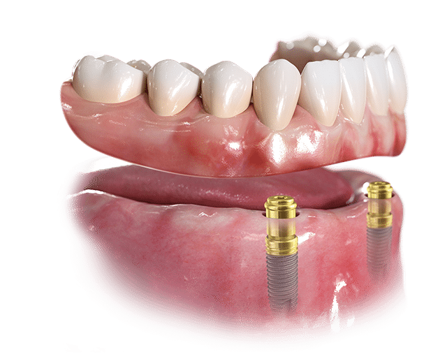 Removable Implant Supported Dentures Procera Bar 2