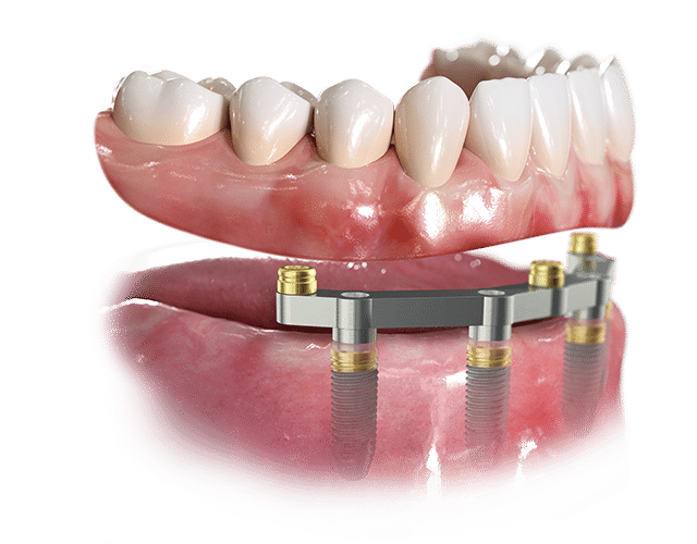 Removable Implant Supported Dentures Procera Bar 2