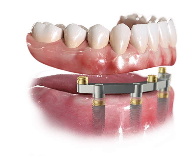 Removable Implant Supported Dentures Parallell MUA