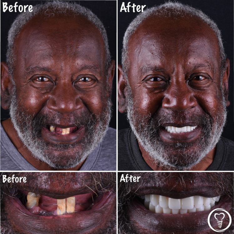 Before and after dental implant cosmetic surgery