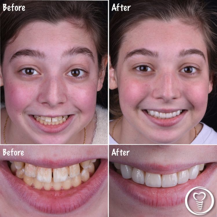 Before and afters of a young patient getting dental services done