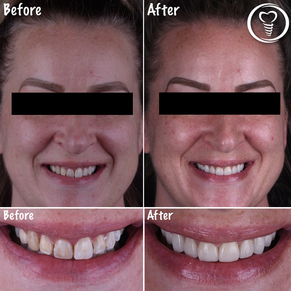 A patient before and after dental work