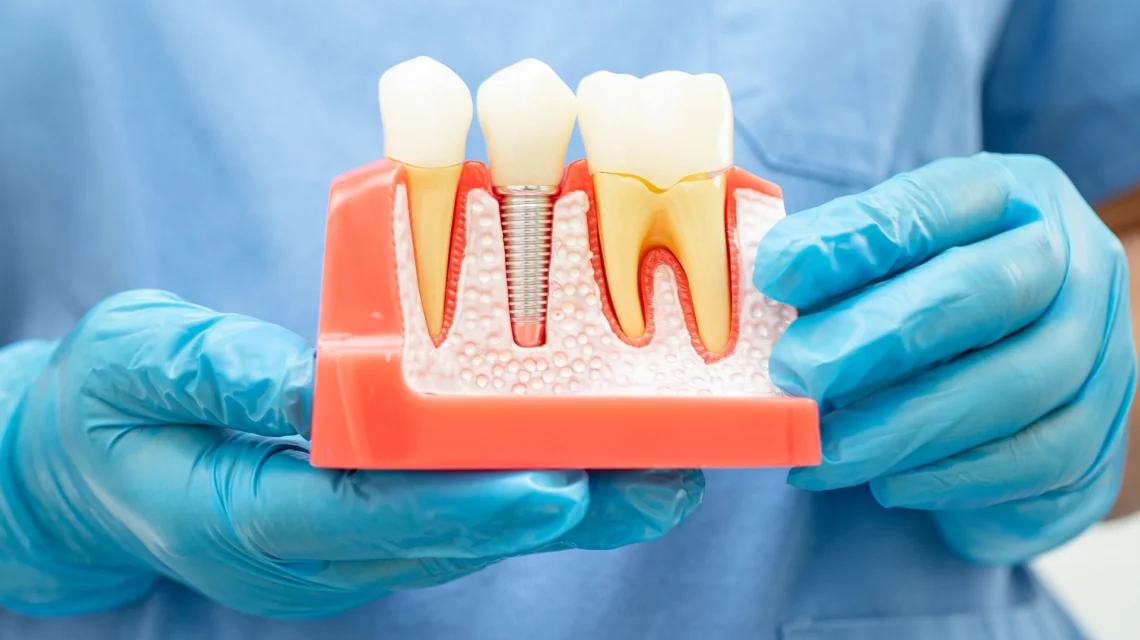 Are There Ever Reasons to NOT Get Dental Implants