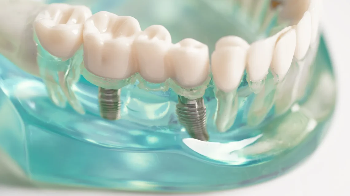 All-on-4 Dental Implant Costs Guide For Florida Residents