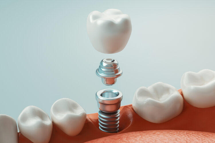 Reclaim Your Favorite Foods with Dental Implants
