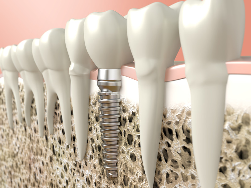 Navigating Dental Implant Options: Your Guide to Choices Navigating Dental Implant Options: Your Guide to Choices