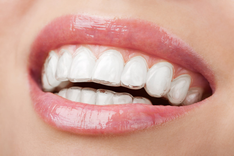 Invisalign in Brandon: A Clear Path to a Straighter Smile