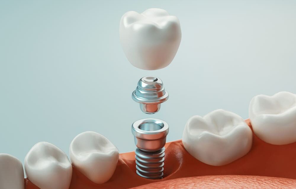Dental Implants: Your Journey to a Restored Smile
