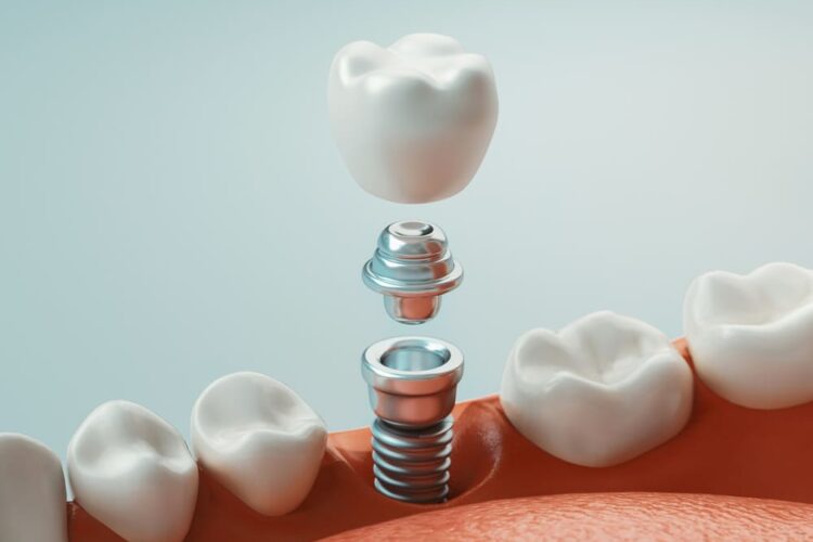 Dental Implants: Your Journey to a Restored Smile