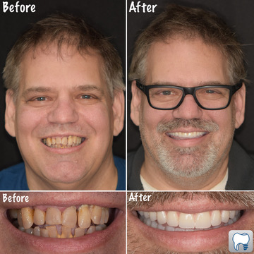 all on 4 dental implants patient