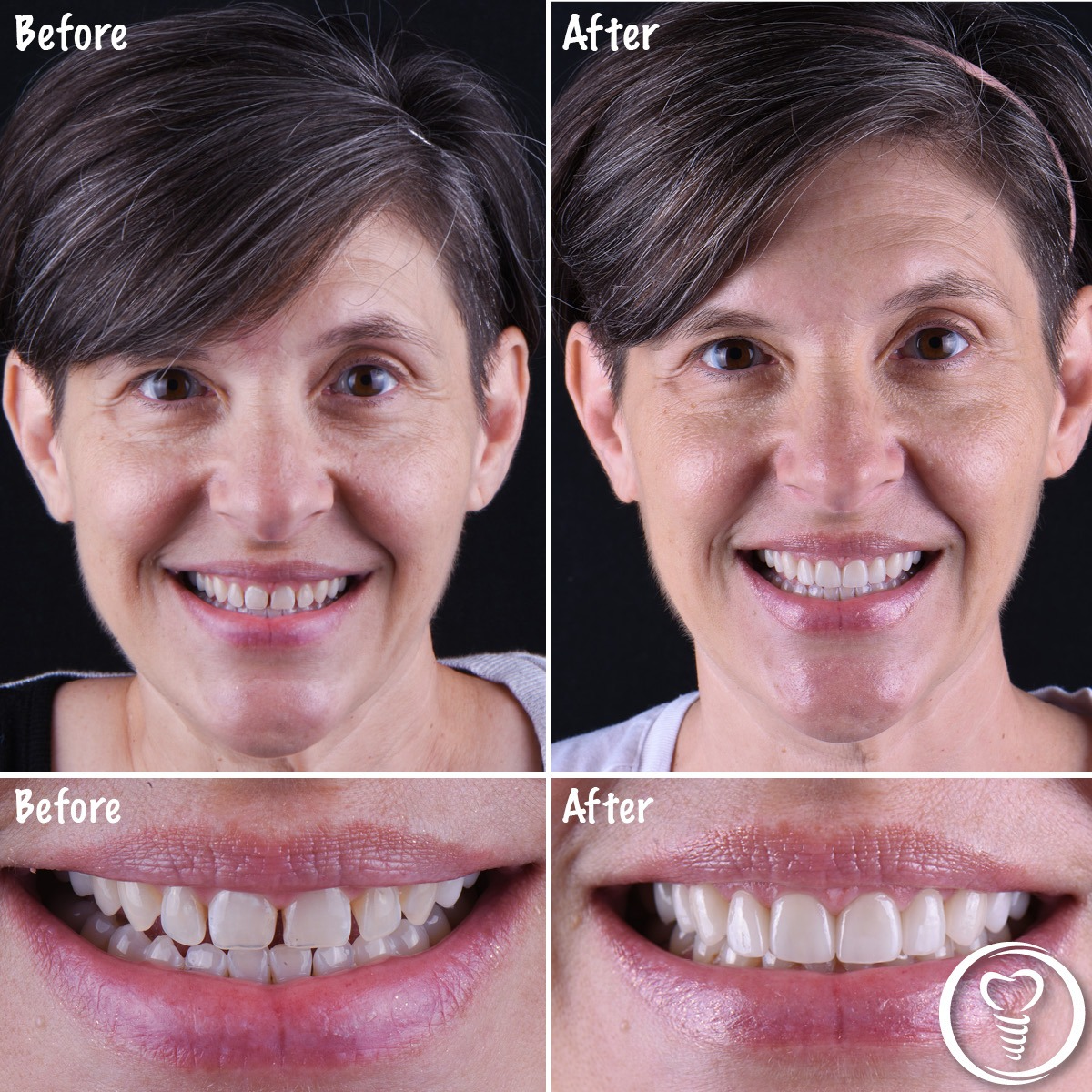 Before and after cosmetic dentistry using crowns and veneers to close gaps and enhance a natural smile in Brandon, Florida