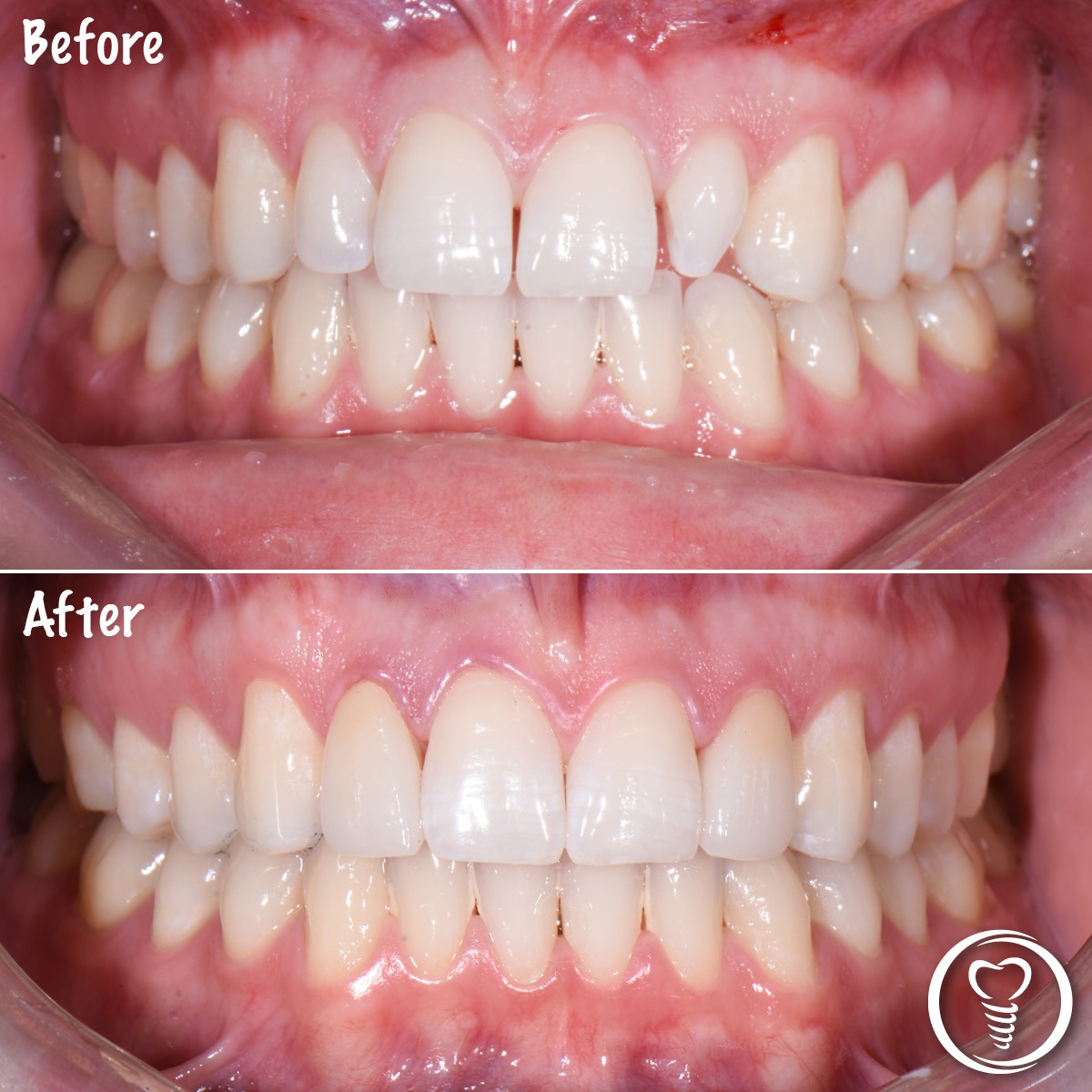 Before and after cosmetic veneers used to enhance a few teeth and create a natural, balanced smile in Brandon, Florida