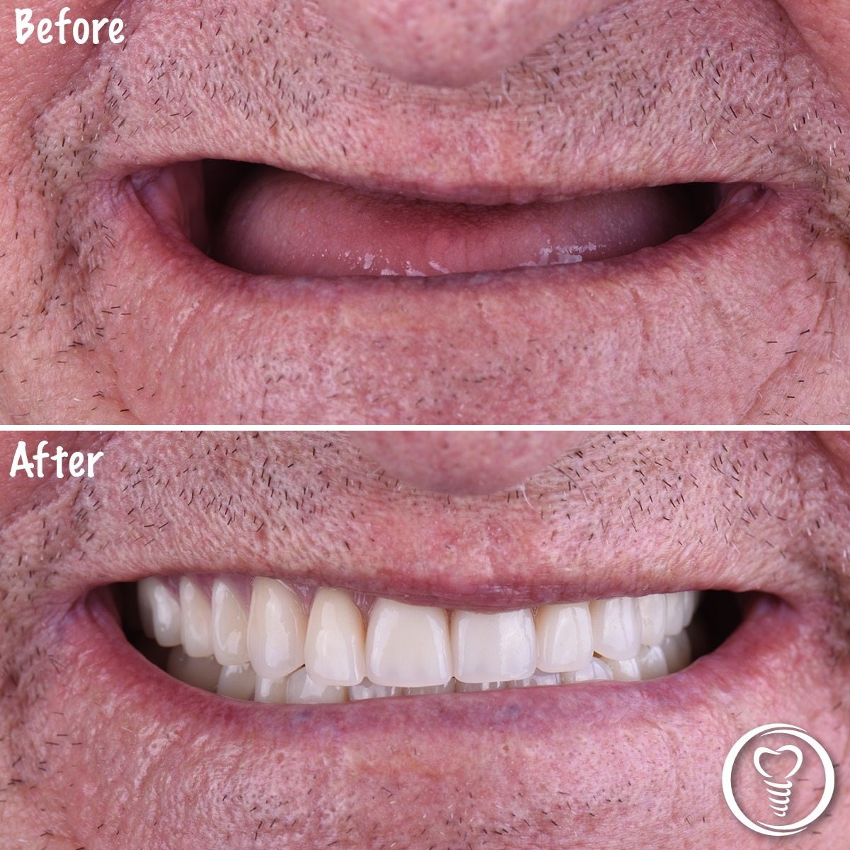 Before and after custom dentures restoring a full smile for a patient with missing teeth in Brandon, Florida