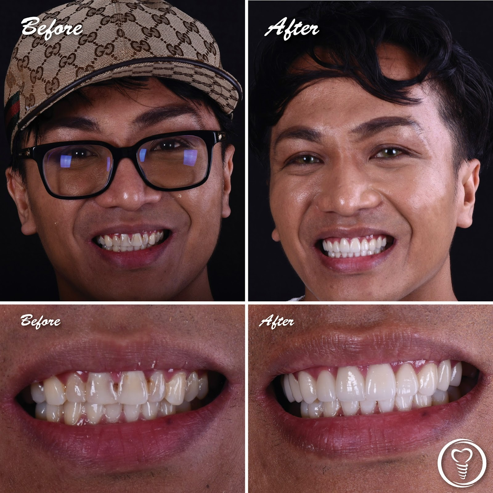 Before and after dental crowns used to treat tooth decay and restore a natural smile in Brandon, Florida