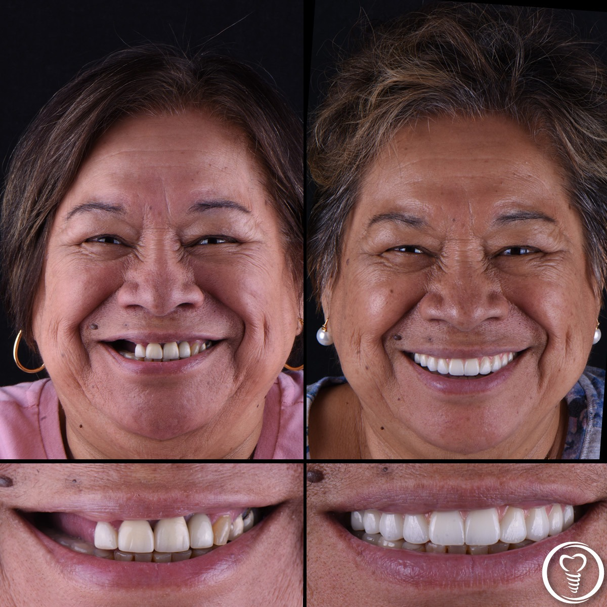 Before and after full mouth dental implants correcting failed implants in Brandon FL