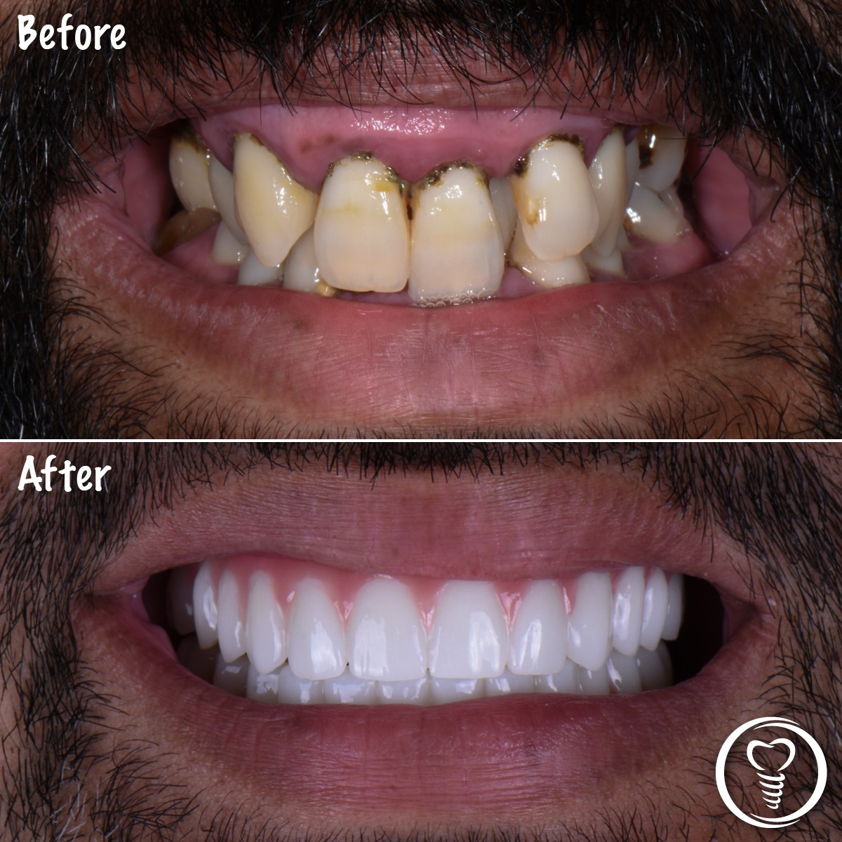 full-mouth-dental-implants-brandon-fl-severe-gum-disease-before-after