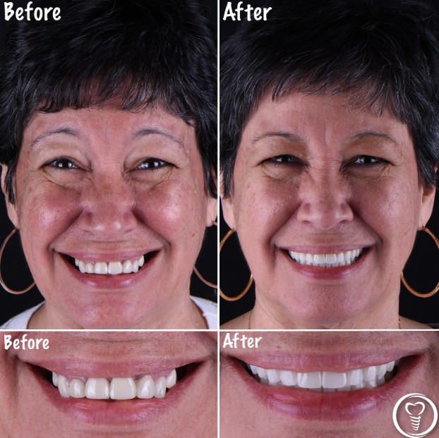 Full Mouth Dental Implants Smile Transformation – Brandon, Florida