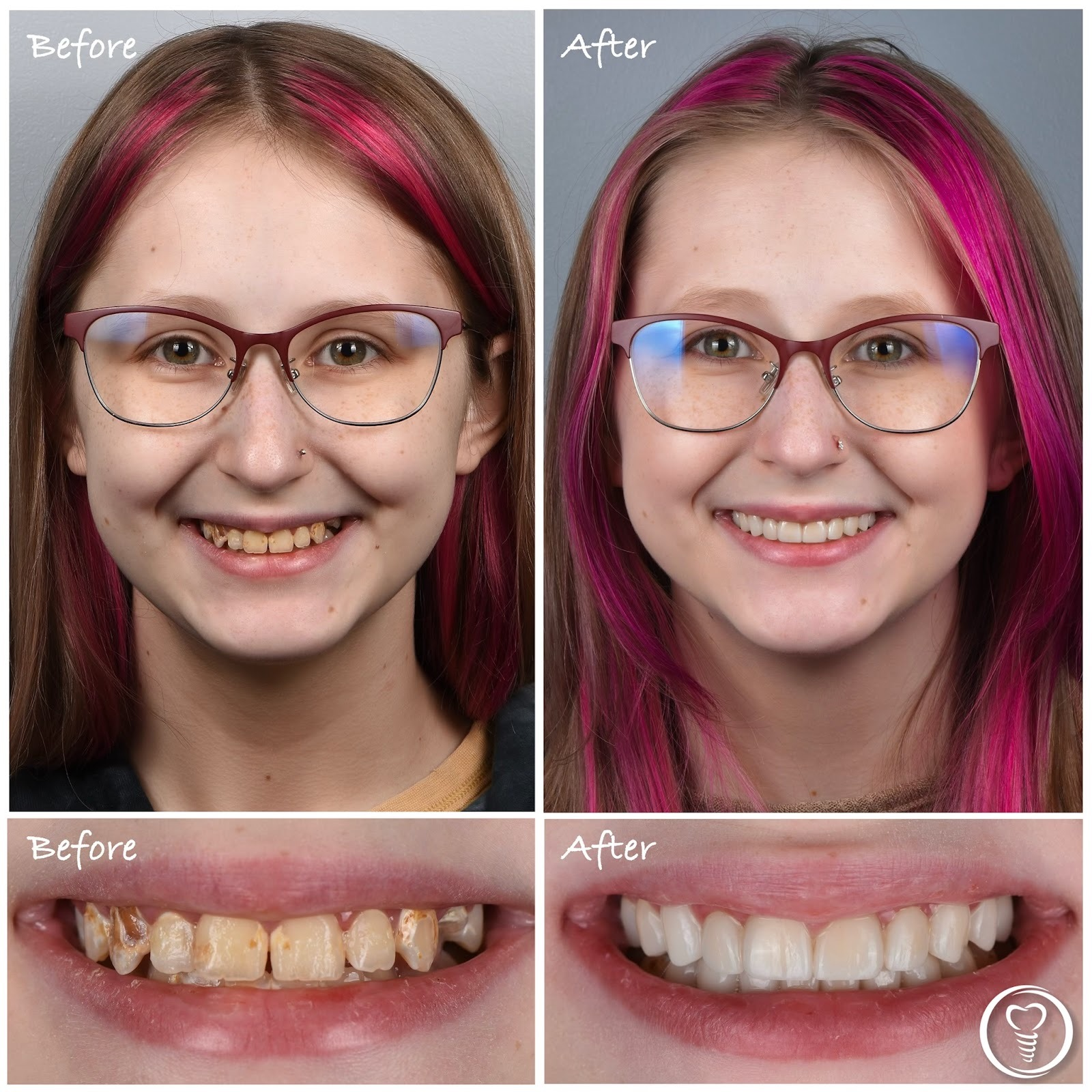 Before and after cosmetic dental crowns used to treat extensive tooth decay and restore a healthy smile in Brandon, Florida