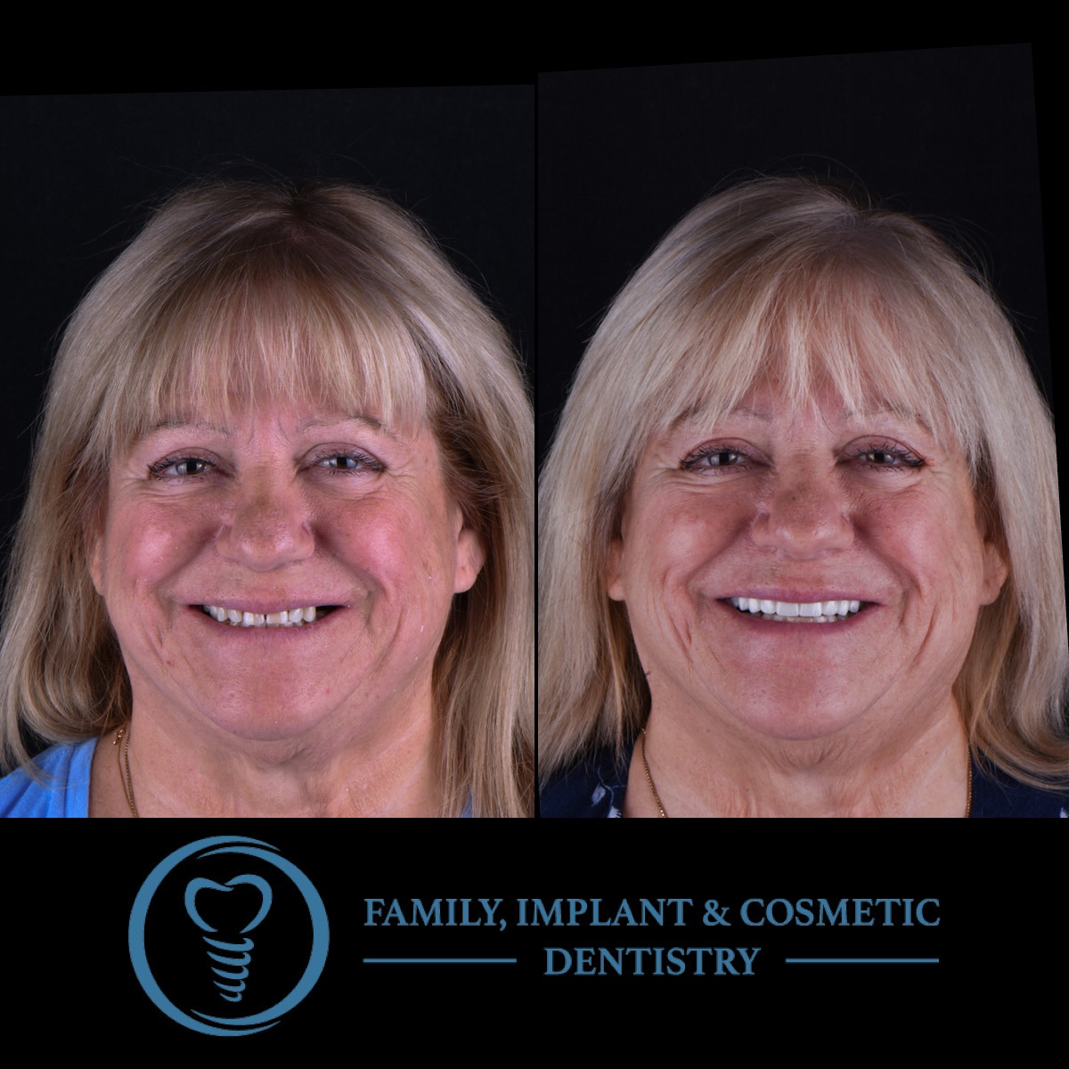 Before and after cosmetic dentistry using dental implants, crowns, and veneers to restore a natural smile in Brandon, Florida