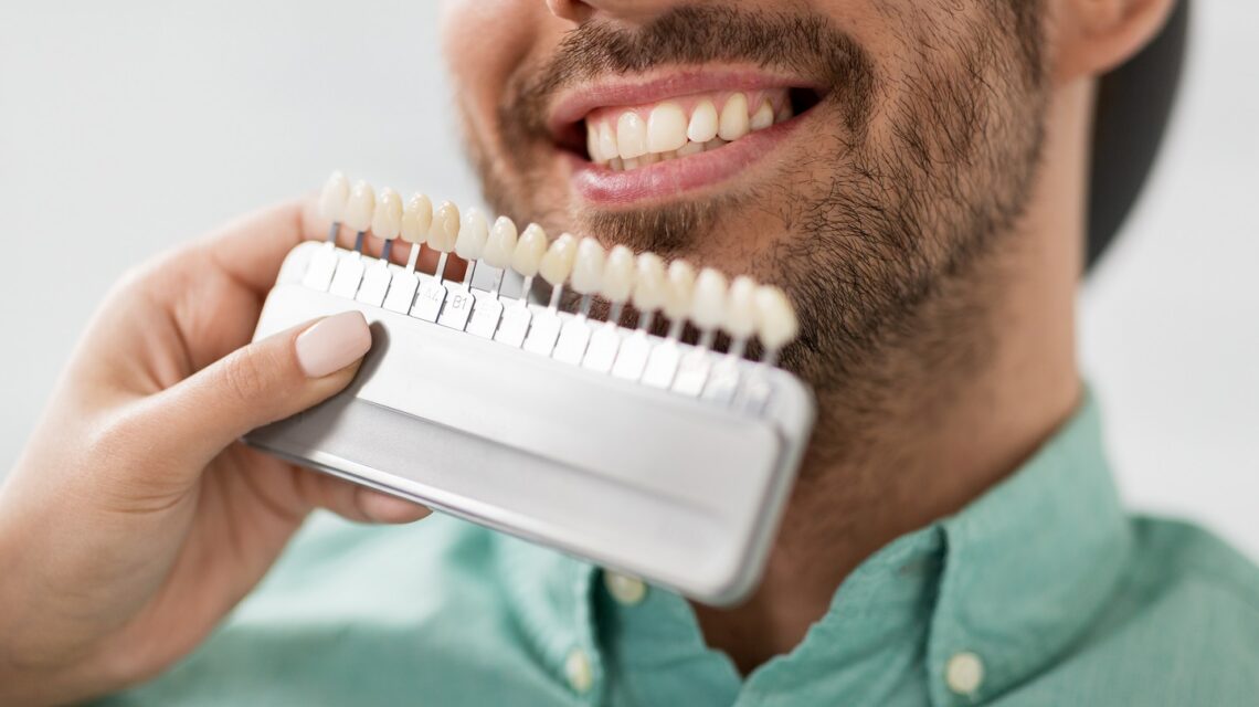 Replacing Veneers: What to Expect and When
